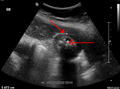 Cholezystitis mit Cholezystolithiasis und verdickter Gallenblasenwand (Sonografie)