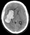 Gehirn: Hämorrhagischer Infarkt