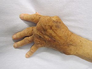 Typische Ulnardeviation bei rheumatoider Arthritis