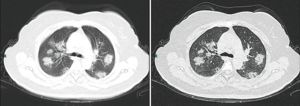 CT imaging of rapid progression stage