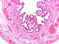 Cholezystitis (Histologie)