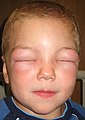 Angioedema: nel bambino