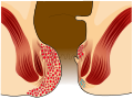 Hämorrhoiden vierten Grades